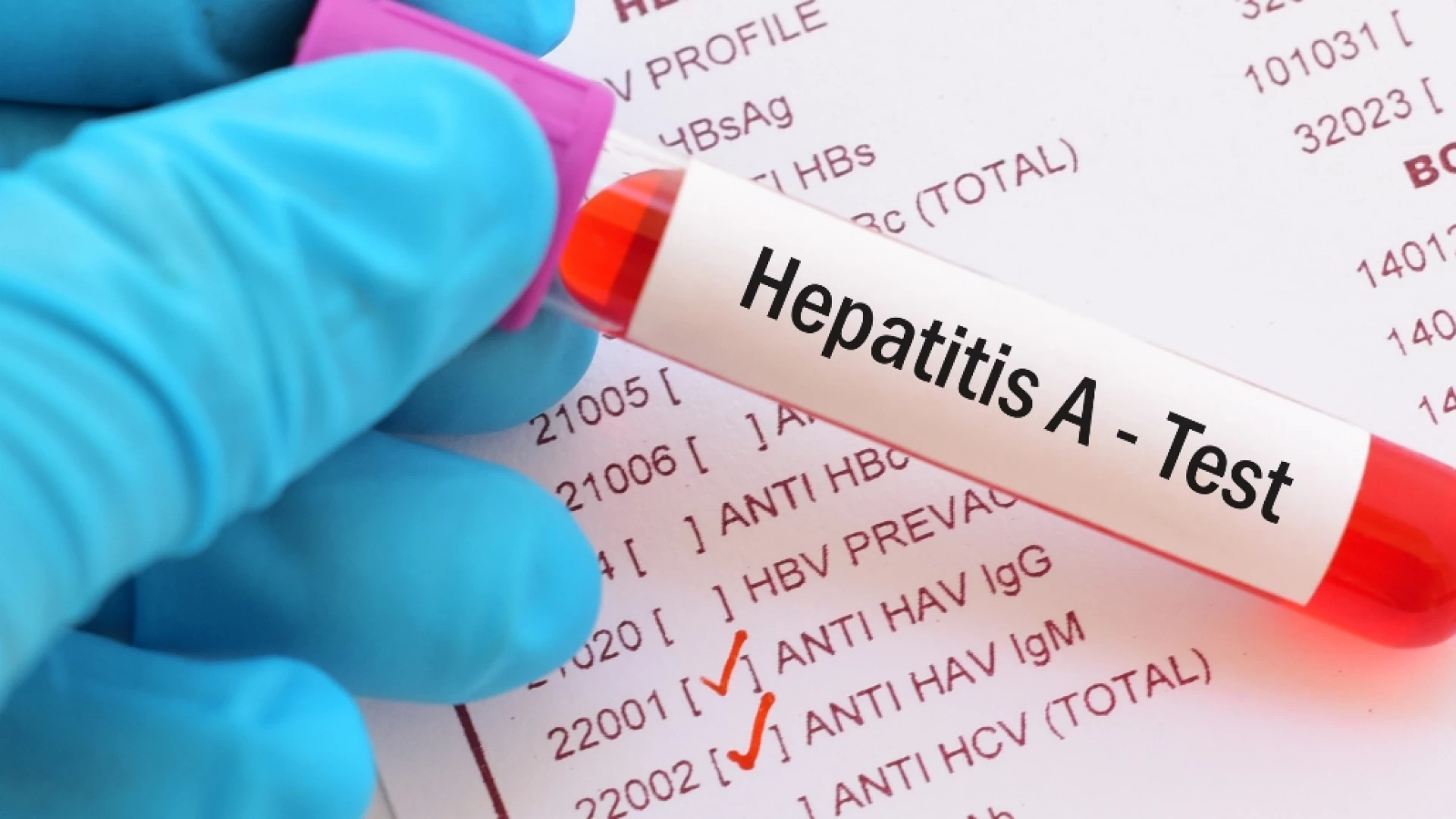 Allarme Epatite A nell'Alto Casertano: massima attenzione ma senza futili allarmismi